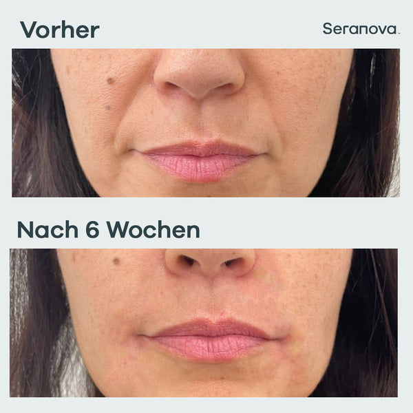 Micro Infusion Patches