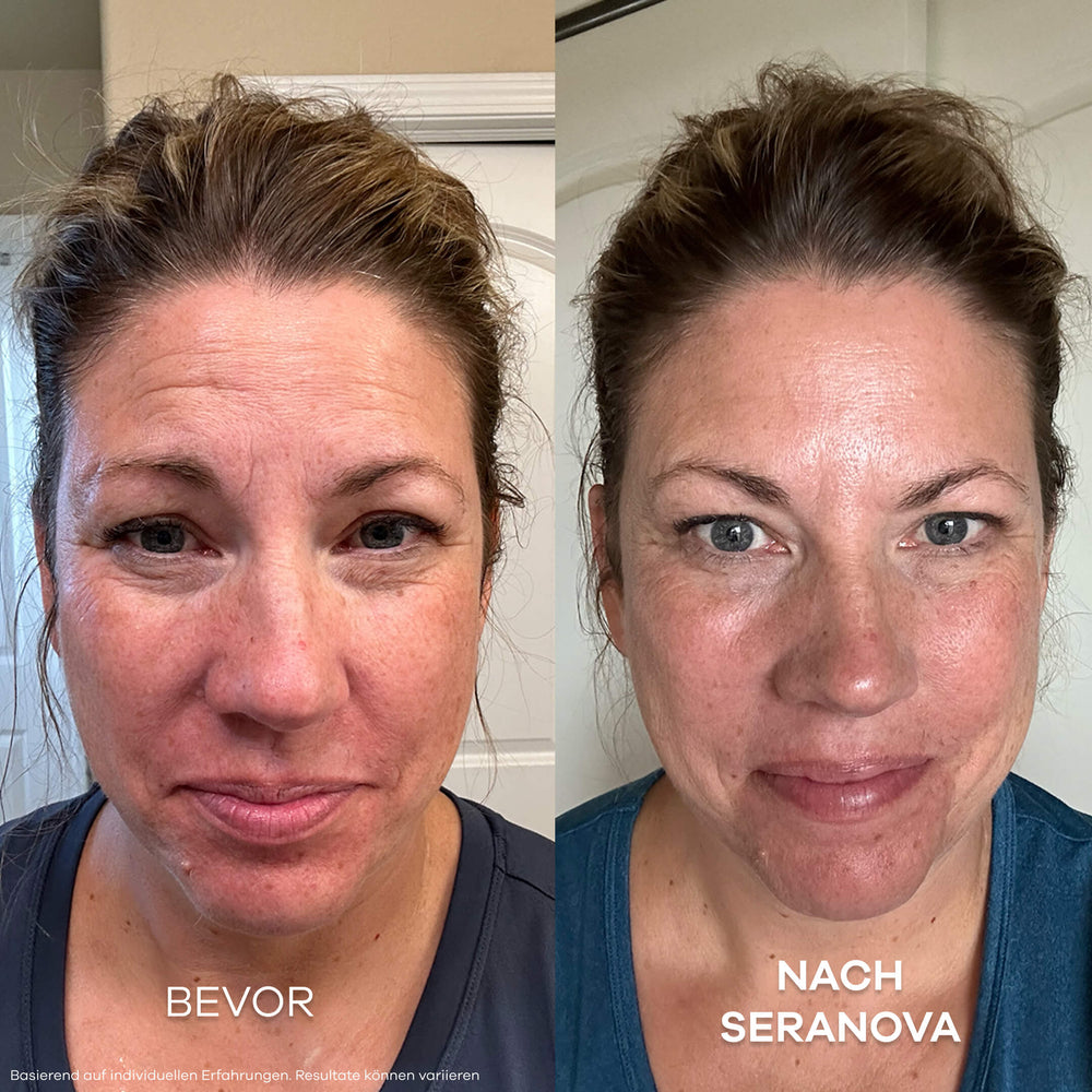 Seluné Micro Infusion System™