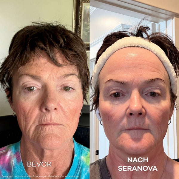 Seluné Micro Infusion System™