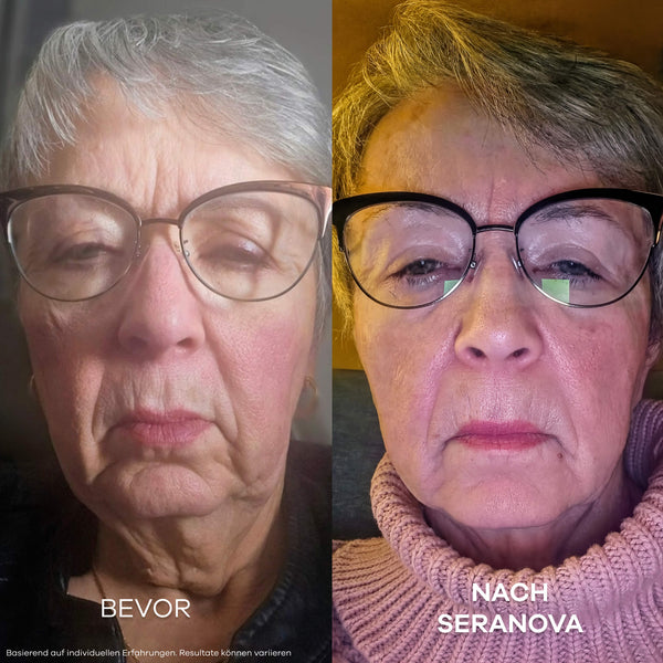 Seluné Micro Infusion System™