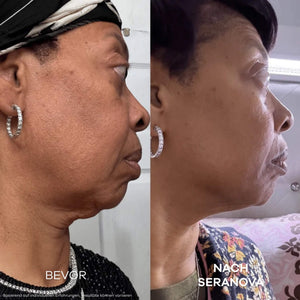 Seluné Micro Infusion System™